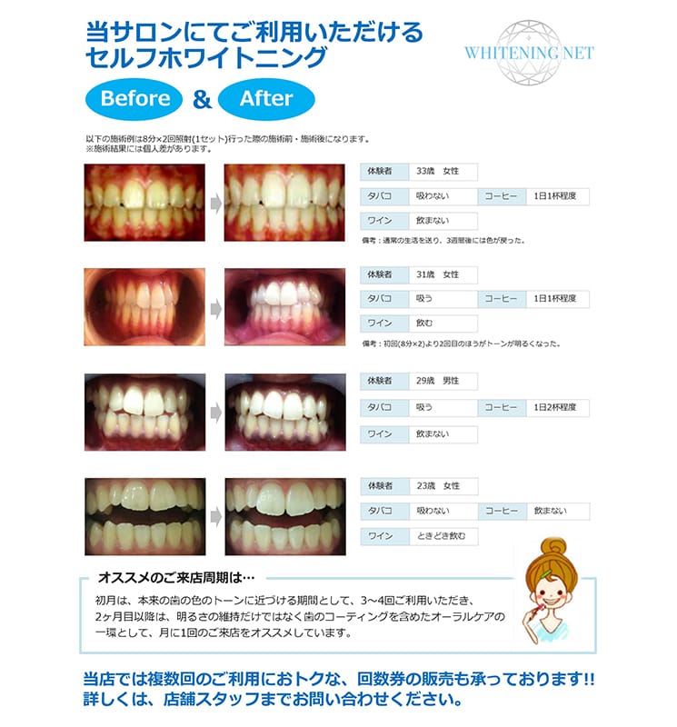 セルフホワイトニング